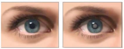 2.3.3. A szem leggyakoribb betegsége, a szürkehályog és annak kezelése A szem leggyakoribb megbetegedés a szürkehályog (cataracta), amely kifejezetten a szemlencsét érinti az egyik, vagy akár mindkét