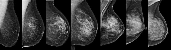 MAMMOGRÁFIÁS DENZITÁS Lundberg és mtsai, Breast Cancer Res, 2016 Karolinska mammographyproject, 43 313 nő, - meddőségi esetek közül: 1576 kontrollált