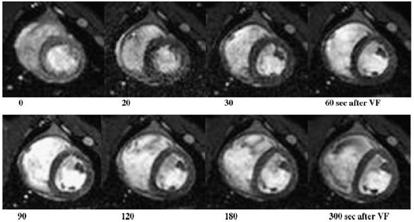 A szívhalál első percei MRI felvételek 30
