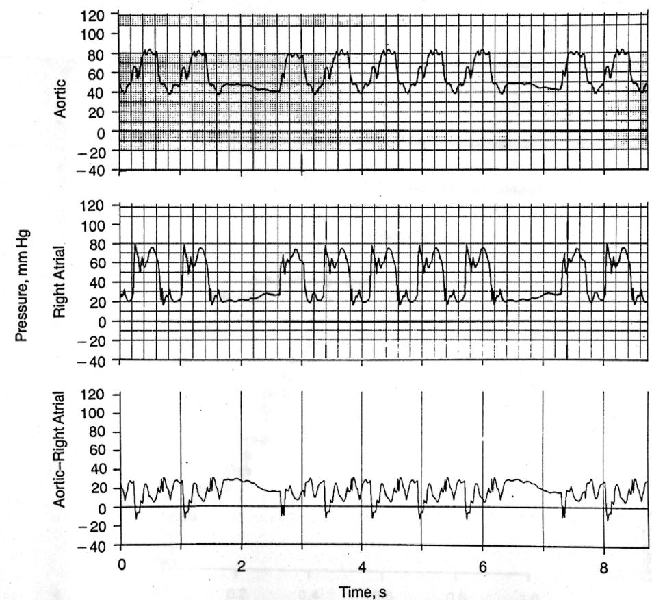 Coronary Perfusion Pressure and Resuscitation (100 beteg