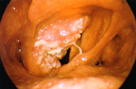 Supraglotticus gégerák (tumor a hangszalag szintje felett) Sebészi kezelés