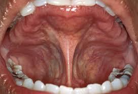 Oralis HPV