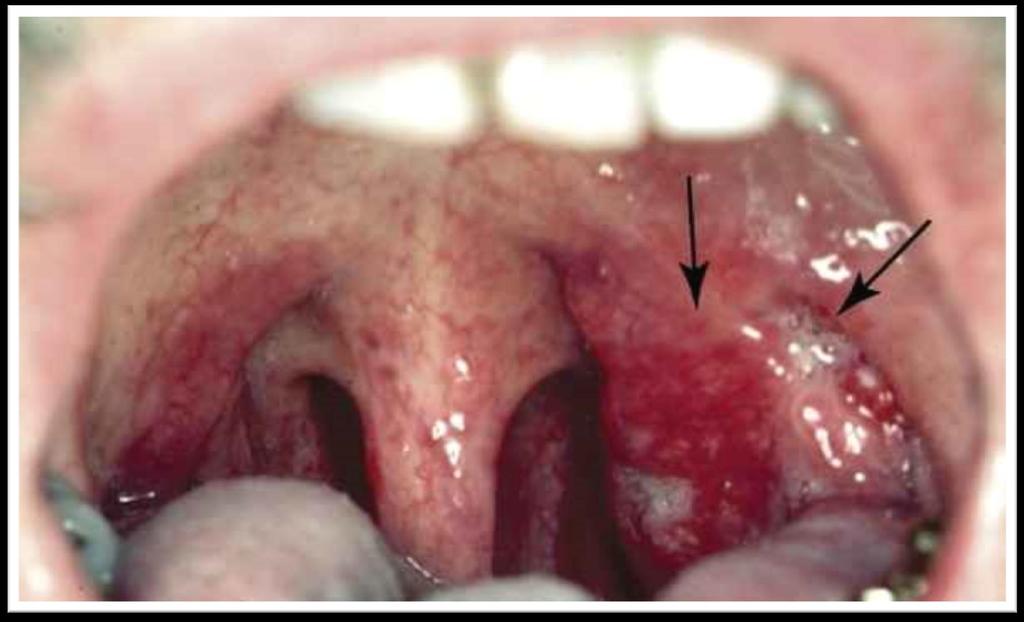 Bal oldali tonsilla carcinoma,