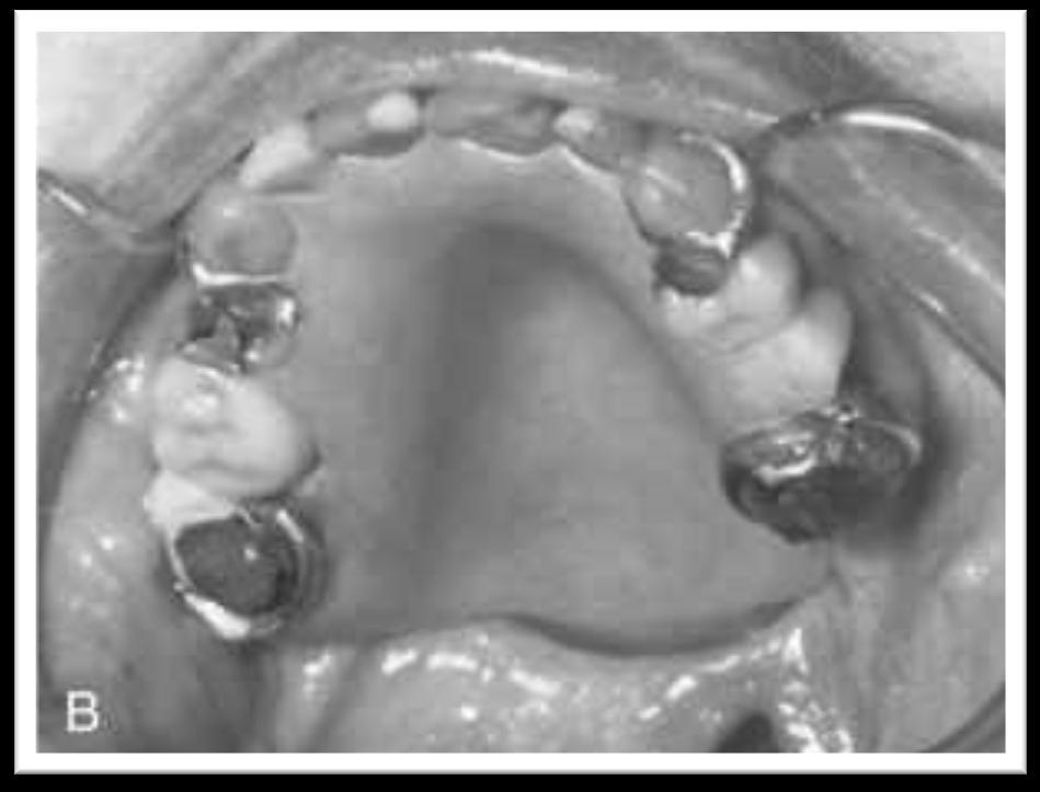 Defektus a maxilla és a szájüreg között B.