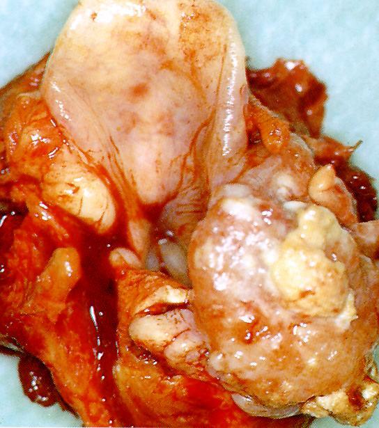 A hypopharynx rosszindulatú daganatai - A szervezetben előforduló daganatok 1-3%-a - A