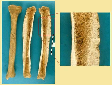 Sebészi trepanáció és többszörös jelképes trepanáció (Balatonújlak Erdő-dűlő, 23.sír, 10. század, Siklósi Zs. ásatása) II.