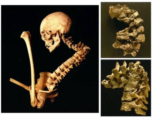 A TBC jellegzetes csonttani elváltozása, az ún. Pott-féle púp (spondylitis tuberculosa) Nagyon jellegzetes a csigolyák, illetve a gerincoszlop gümőkórja, a spondylitis tuberculosa.
