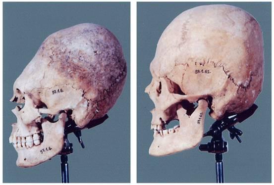népekkel. A hunokról szóló korabeli beszámolók ( Ammianus Marcellinus, Priszkosz rhetor) nem említe ék a koponyatorzítás szokását.