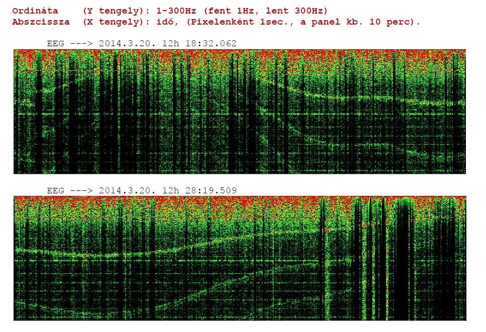 Eredmények 66 A magzati EEG regisztrálásához az előző fejezetben említett fejskalp elektróda speciálisan módosított változatát használjuk.