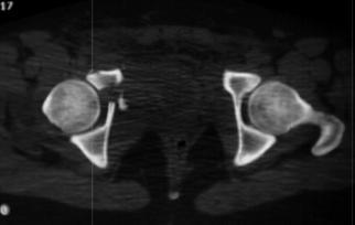 CT Osteoid osteoma - nidus,