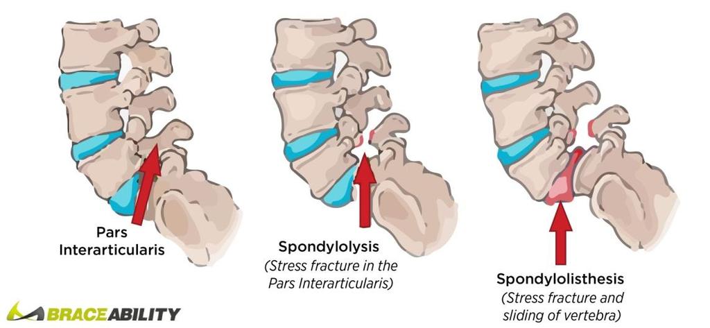Spondiolisthesis : a gerincoszlop előrecsúszása