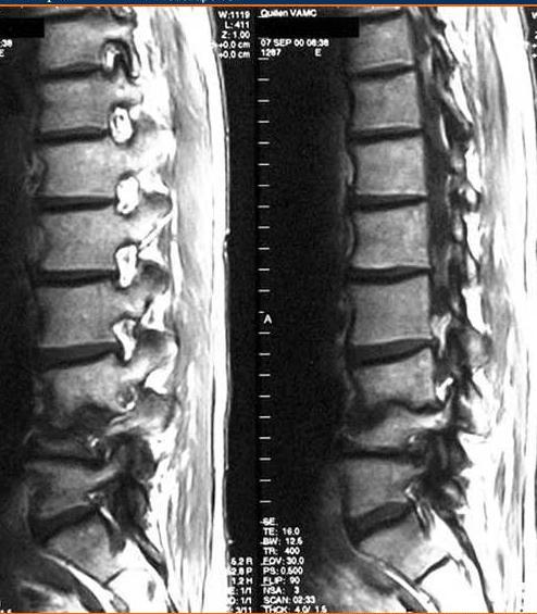 SPONDYLITIS, SPONDYLODISCITIS bőséges arteriális ellátás, közvetlenül is fertőződhet Rtg: viszonylag későn, 2-8 héttel a tünetek megjelenése után CT: