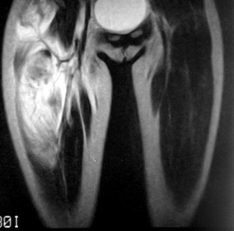 MYOSITIS OSSIFICANS Jó indulatú solitaer izomterime