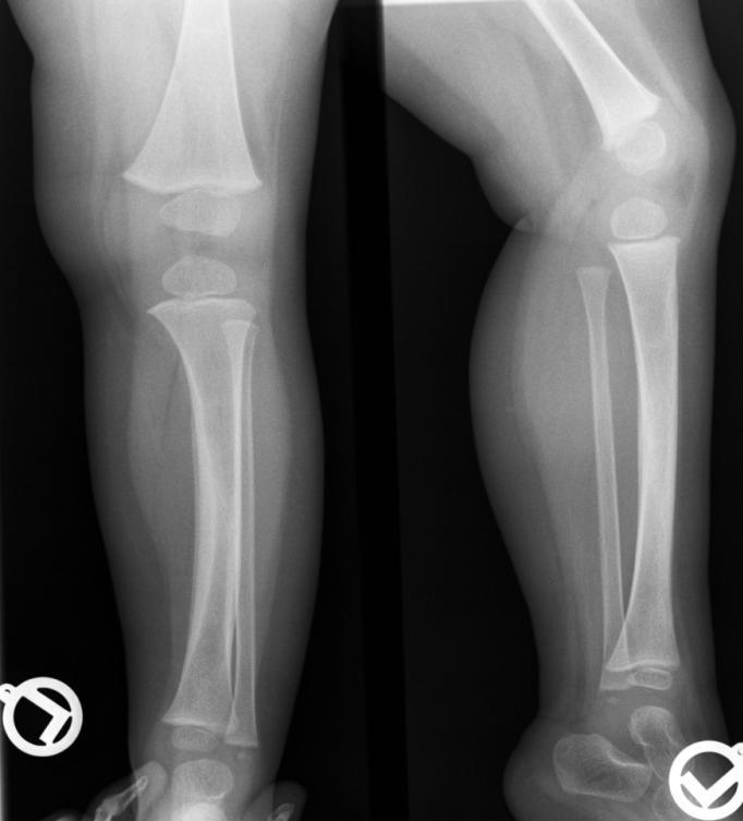 LÁBSZÁR, BOKA Toddler fractura Dislocatio nélküli spiráltörés a distalis tibiában 9 hónapos, 3 éves