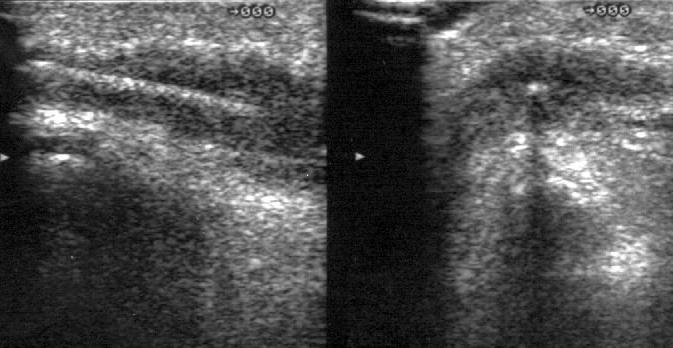 metatarsus fejecse Köhler: tarsus,naviculare Sever: calcaneus