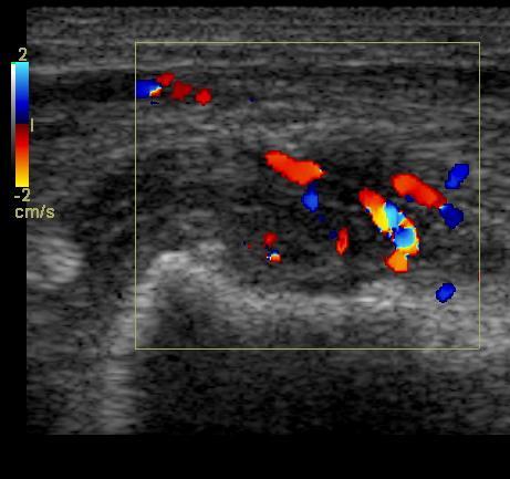 folyadék Izületi folyadék Doppler: fokozott