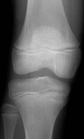 OSTEOMYELITIS RADIOLÓGIAI KÉP 7-10 nappal a