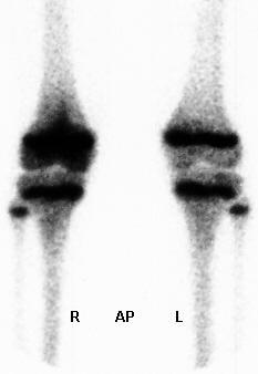 egyenetlen porosis Késôbb: osteolysis,