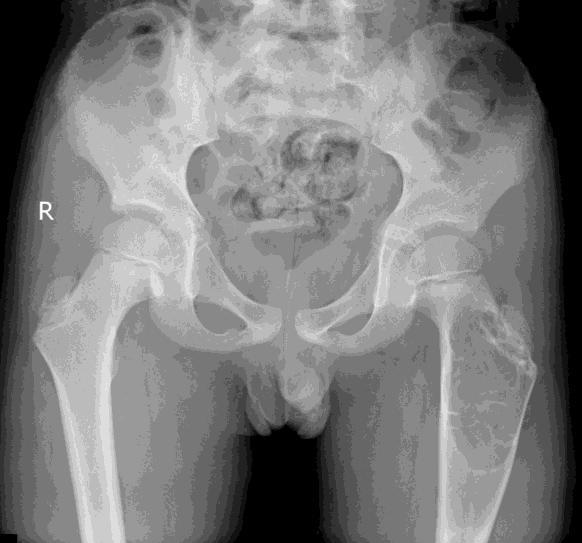 BENIGNUS CSONT TUMOR Osteochondroma