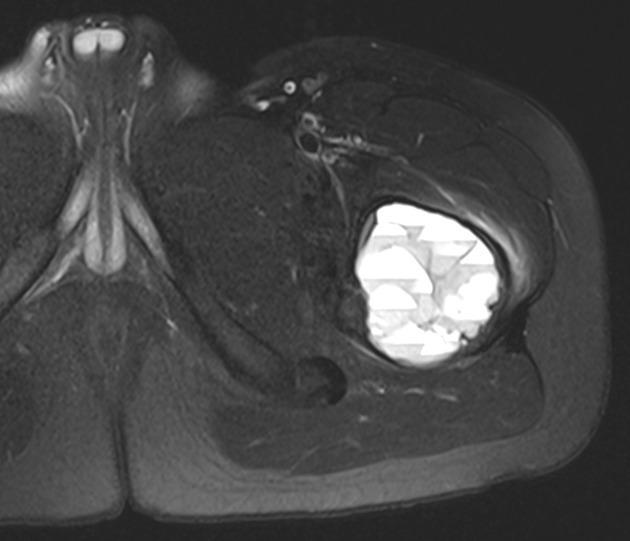 Fibrosus dysplasia Egyszerű csont