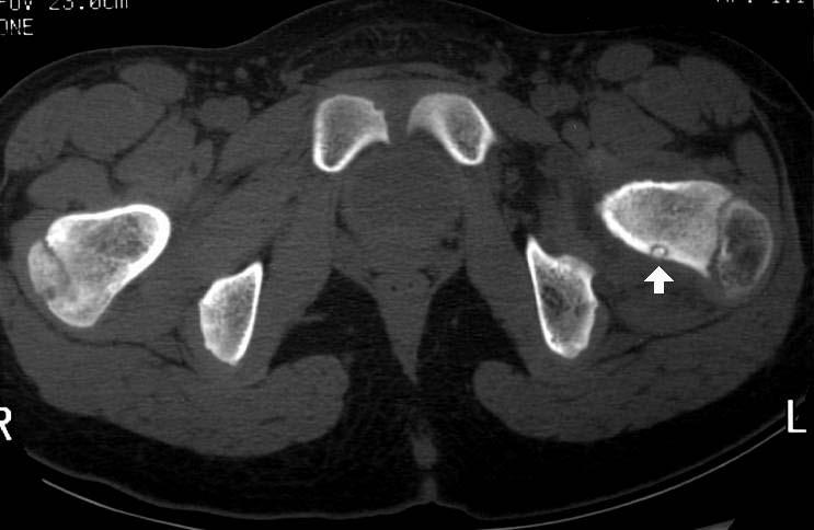 OSTEOID OSTEOMA Benignus csont tumor,