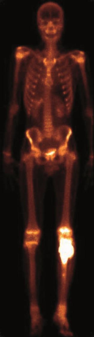 metaphysis Multiplex laesio: leukemia histiocytosis x