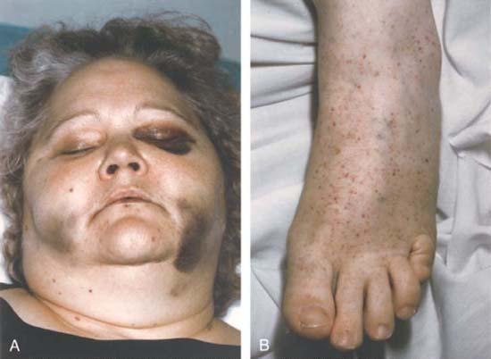 Ecchymosis Petechia Generalizált gyulladás Sepsis