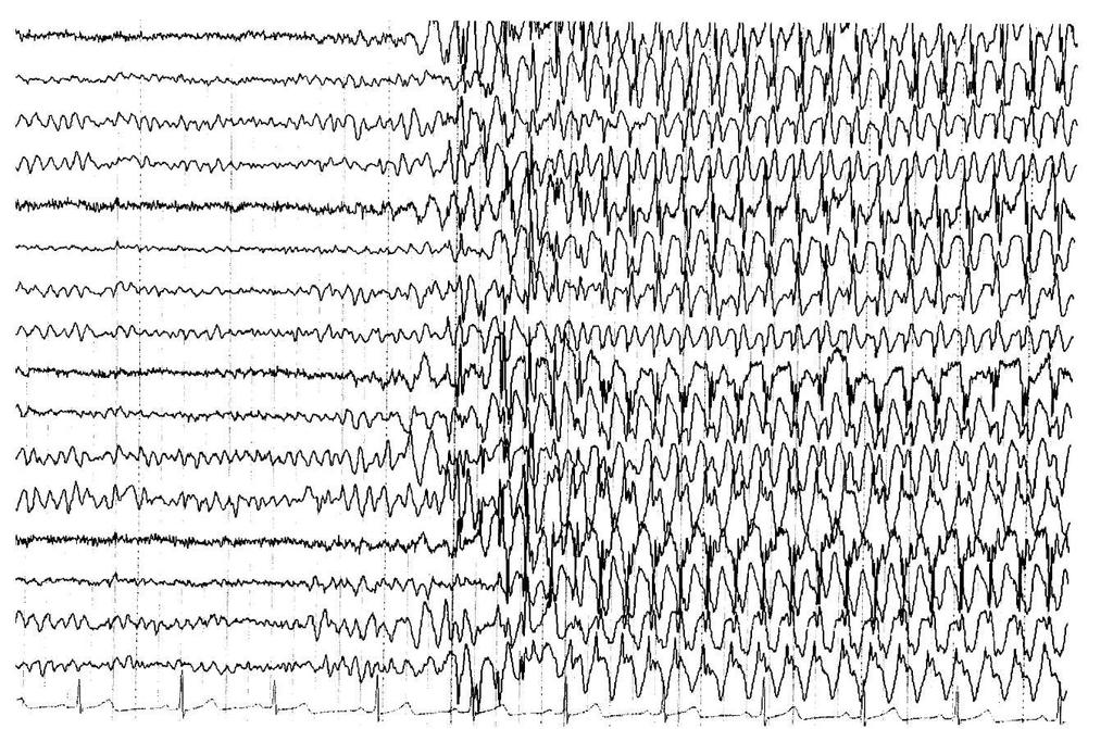 Formái: Generalizált: az epileptikus működés szimmetrikusan mindkét félteke területeire kiterjed, a