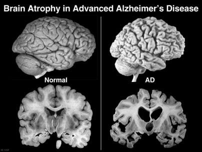Alzheimer kór: A demenciák ~10%-a visszafordítható (reverzibilis) típus: kiváltó ok kezelésével a tünetek megszüntethetők vagy legalábbis jelentősen javíthatók.