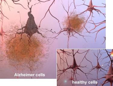 Alzheimer-kórban azonban jellemző az idegsejtek típusa, valamint károsodásuk és pusztulásuk lokalizációja.
