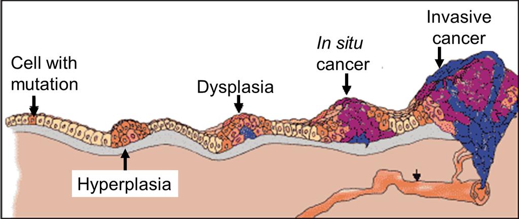 A rák kialakulása mutációval kezdődik: megváltozott sejtek gyorsabban osztódnak és felszaporodnak (hiperplazia).