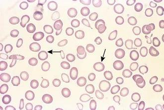 Tünetek, kórisme Általános tünetek Laboreltérések: Hb, Htk, MCV, MCH, anisocytosis, poikilocytosis, se-fe,