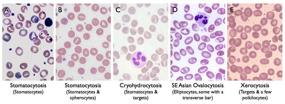 Membránzavarok Sphaerocytosis, elliptocytosis, stomatocytosis, xerocytosis A klinikai kép változó: anaemia, icterus,