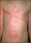 Urticaria