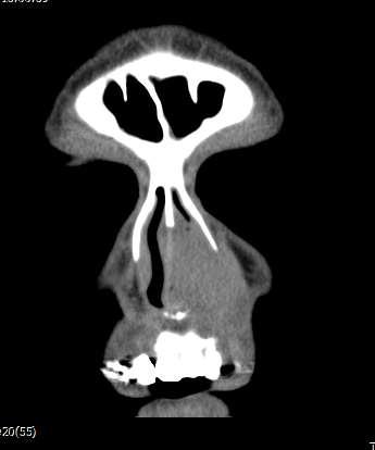 carcinoma