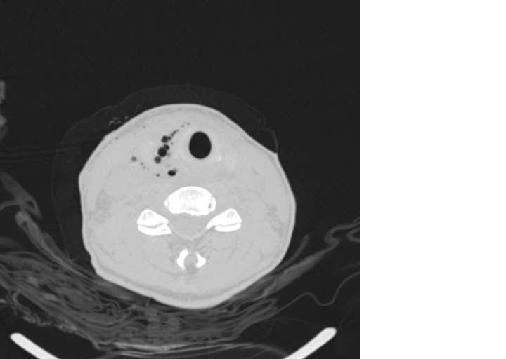 Retropharyngeal tér