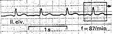 A normális EKG-görbe potenciálváltozások sorozata melyek hullámokat adnak a pozitív irányú kitéréseket felfelé ábrázoljuk 4./13 Somogyi Magdolna részei: 1.