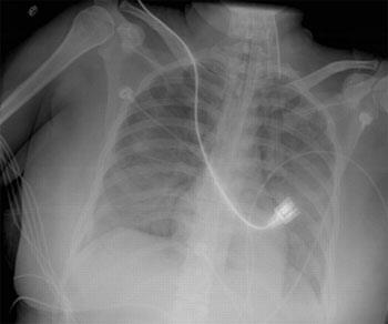 The patient has an endotracheal tube in place and has diffuse bilateral alveolar infiltrates and a normal cardiac silhouette.