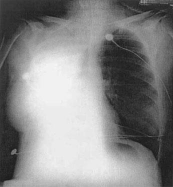 II. Immunológiai szövődmény Transzfúzióhoz társuló akut tüdőkárosodás /TRALI/ 34 éves nőbeteg Tüdőtranszplantáció