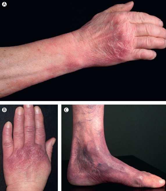 Erythema chronica atrophicans Hosszan fennálló vörös, v.