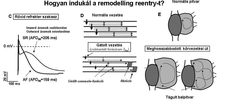 WL (Wavelength) = ERP x ingerületvezetési sebesség (Allesie teoriája A reentry