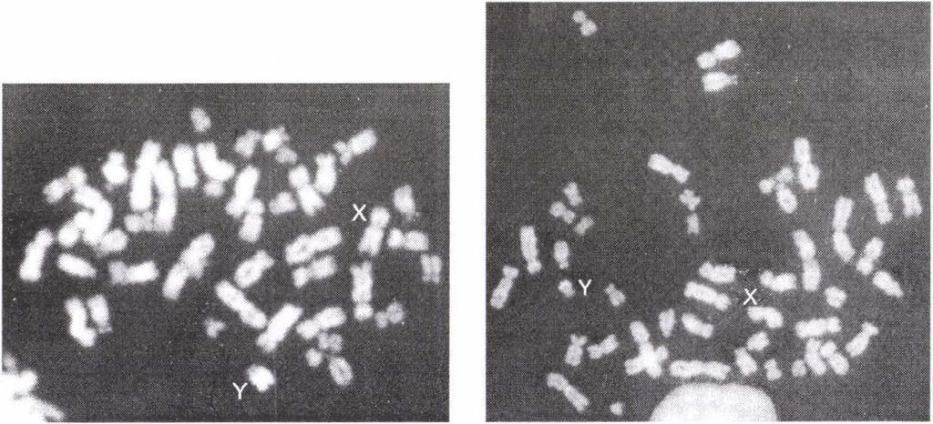 Figure 2: Deleted Y and broken X chromosome (FISH). 3. ábra: Hatalmas, fluoreszkáló Y kromoszóma (Q-sáv).