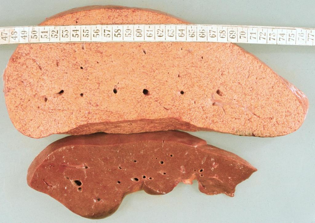 Alkoholos steatosis hepatis: a máj