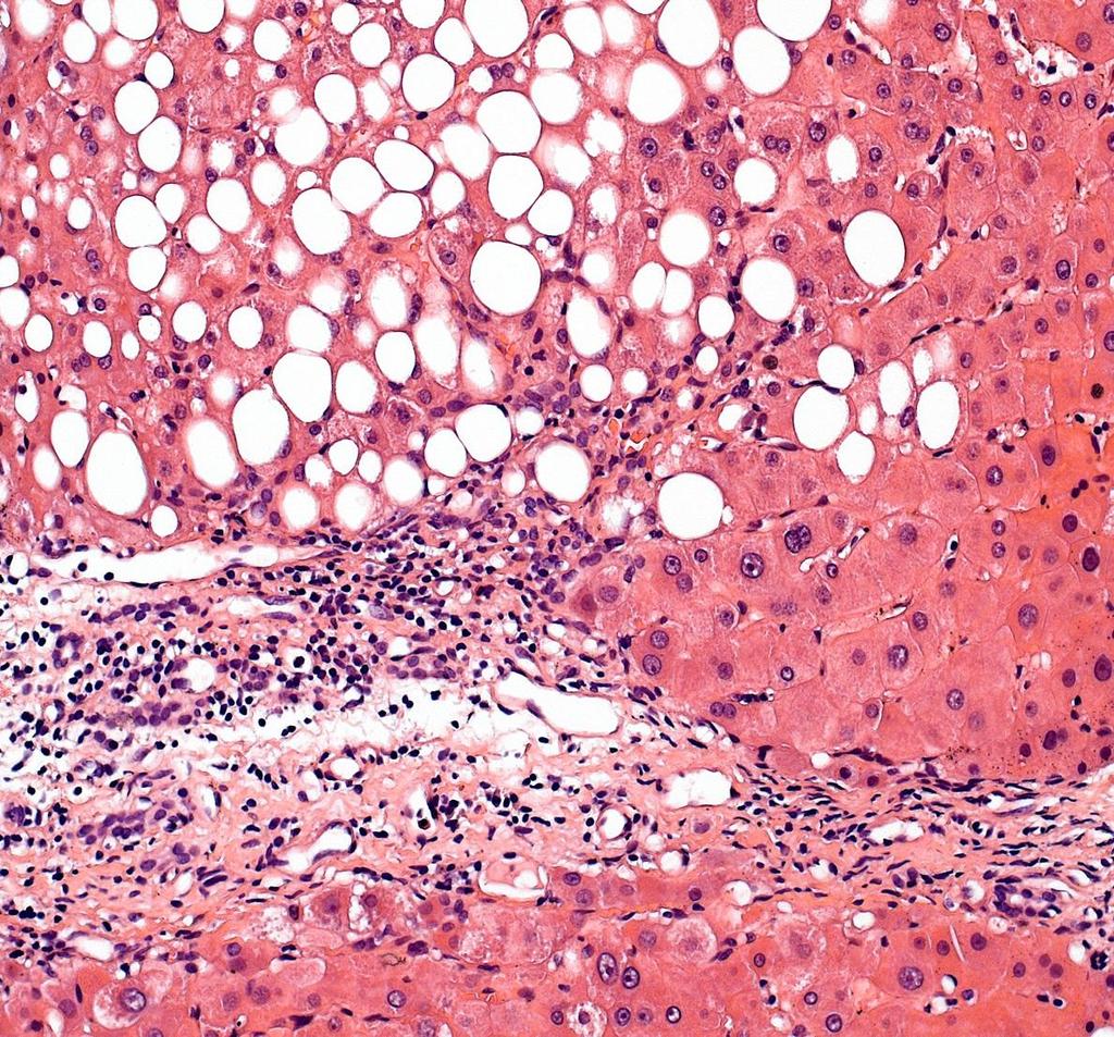 Nem-alkoholos steatohepatitis: vegyes cseppes elzsírosodás, a