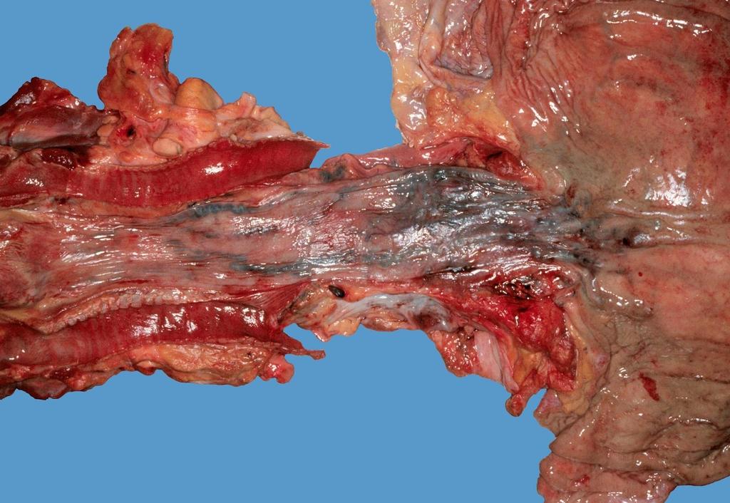 Oesophagus varixok: a distalis nyelőcsőben tág submucosus