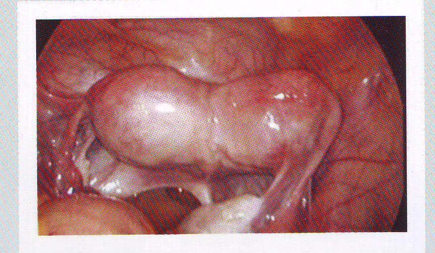 recurrens abortus esetén