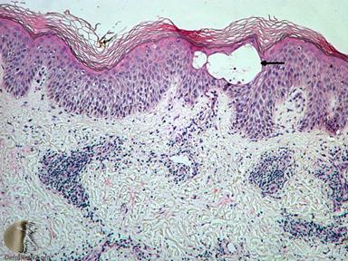 spongioticus mintázat - ekzema Szöveti kép változó - akut spongiosis A stratum corneum szabályos Intercelluláris epidermális ödéma Spongioticus microvesiculák +/-