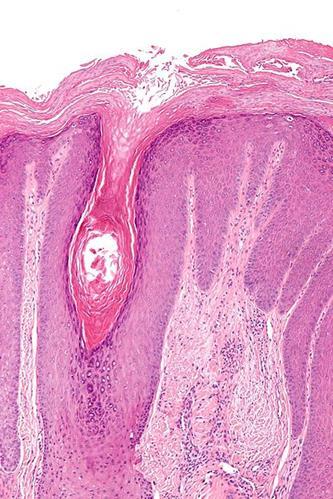 Acanthoticus mintázat - lichen simplex chronicus (LSC) Szöveti kép Kompakt hyperkeratosis Parakeratosis -/fokális Irregiláris
