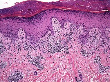 lichenoid mintázat - lichen planus - cutan Inflammatory Dermatopathology - Billings Kompakt hyperkeratosis Nincs parakeratosis Vaskos