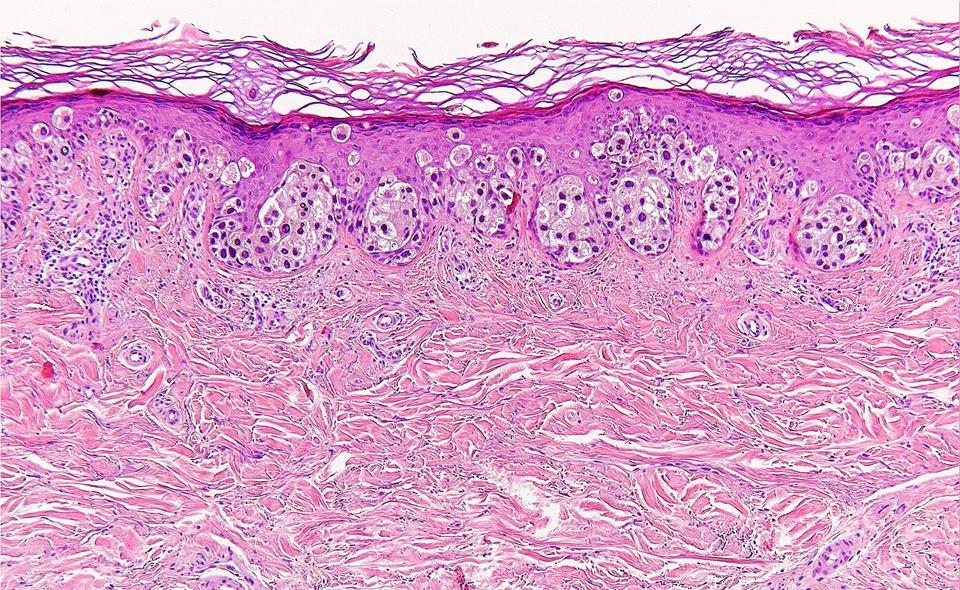 Melanocytás elváltozások - Melanoma Melanoma SSM